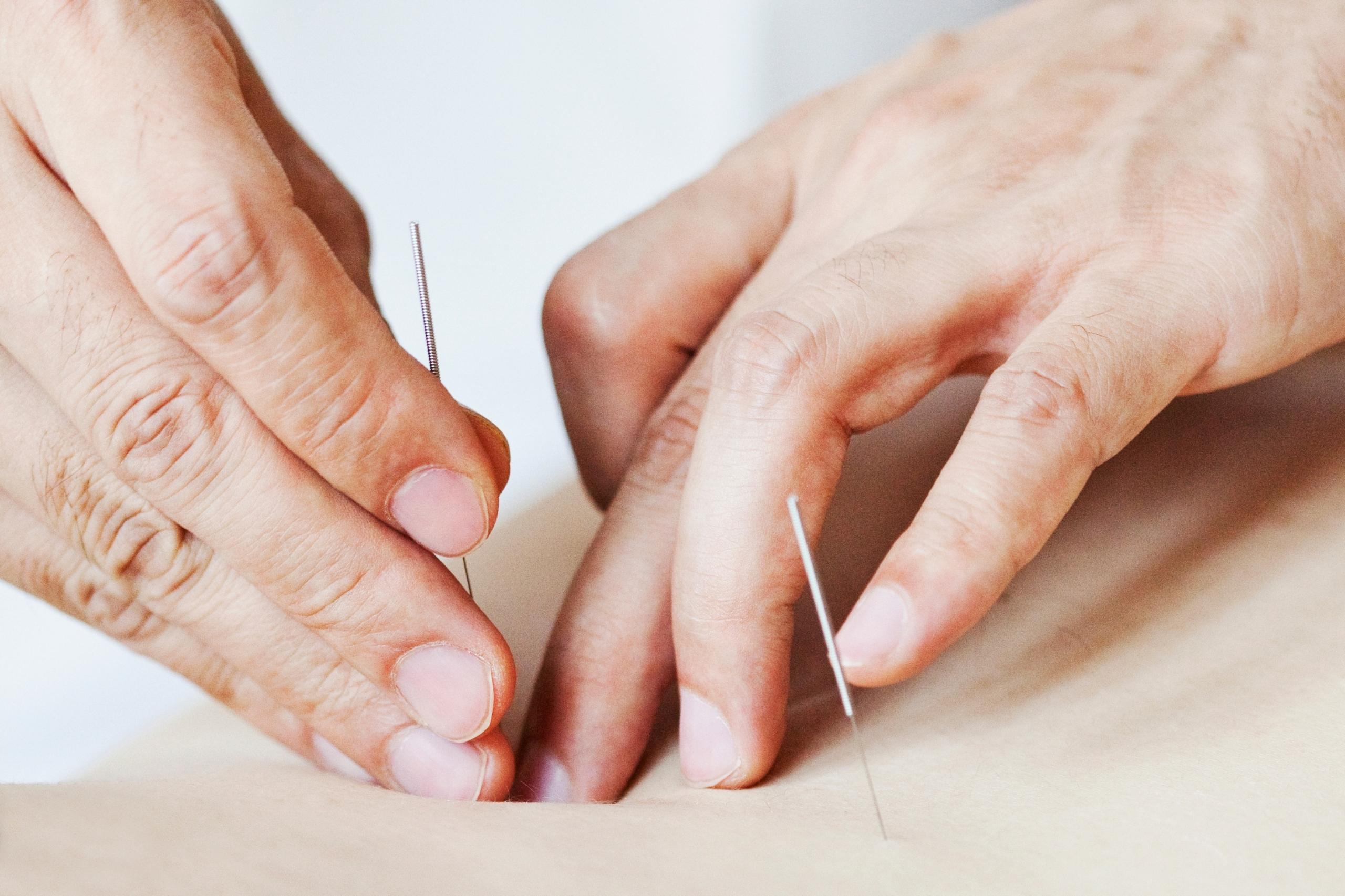 acupuncture treatment